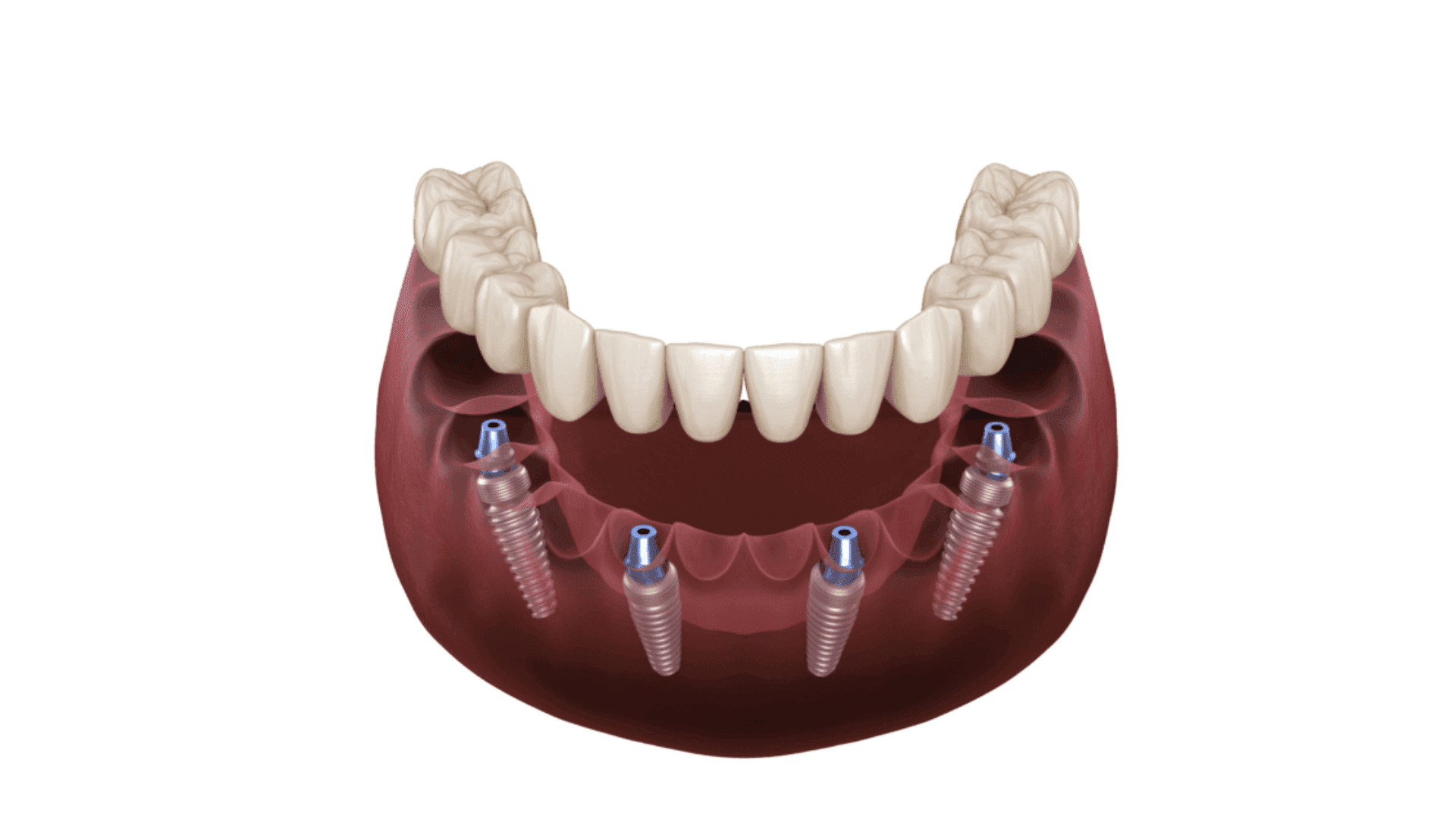 Digital illustration of a full arch implant plan with four implants supporting an arch